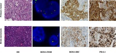 Case Report: High-Level MET Amplification as a Resistance Mechanism of ROS1-Tyrosine Kinase Inhibitors in ROS1-Rearranged Non-Small Cell Lung Cancer